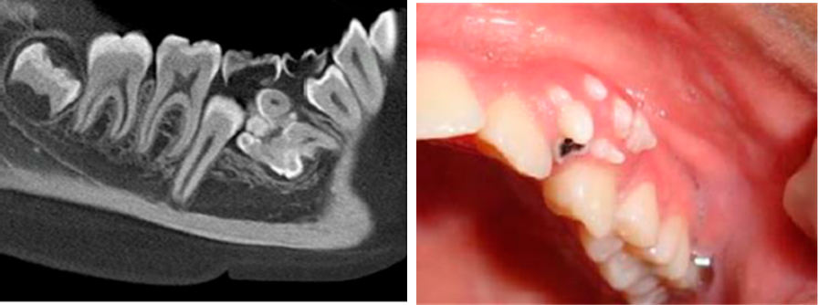 Dental hamartoma (Odontoma) with extra pieces or remnants of teeth